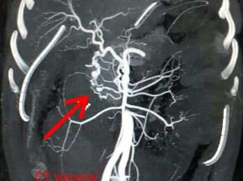 CT visceral angiogram showing string of pearls like aneurysms along deuodenal c loop