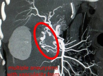 multiple aneurysms with vascularity from celiac n SMA