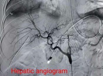 hepatic angiogram normal