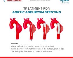 treatment for aortic-aneurysm-stenting