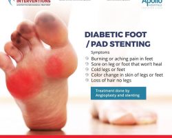 Diabetic Foot/ PAD Stenting - Vascular Interventions