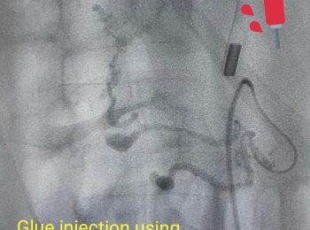 glue injection using micro catheter