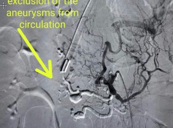 angio showing exclusion of the aneurysms from circulation