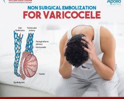 non surgical embolization for varicocele - Vascular Interventions