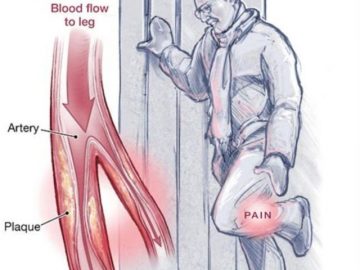 Treatments for Blood Clots in Leg