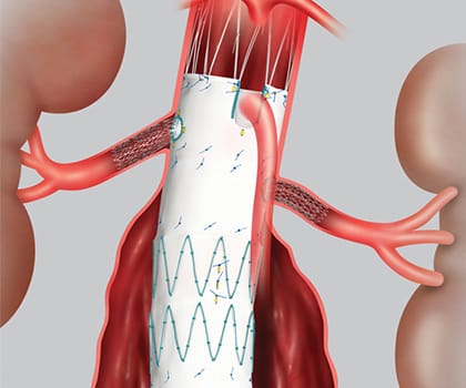 Chemoport Insertion, Varicose veins, Vascular surgeon