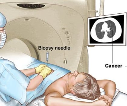 CT USG guided RFA and Biopsy