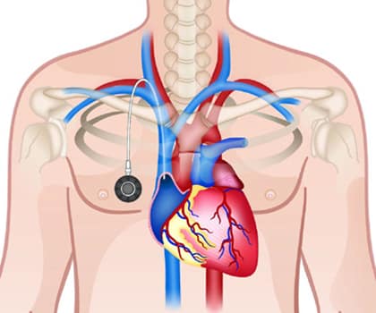 Chemoport Insertion