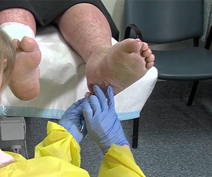 Diabetic Foot Vascular Surgery