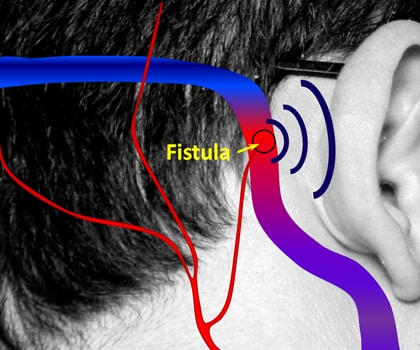 Dural Arteriovenous Fistula