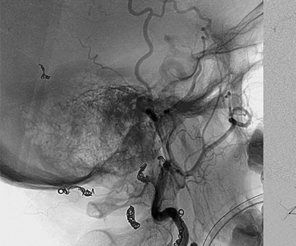 Pre Operative Embolization