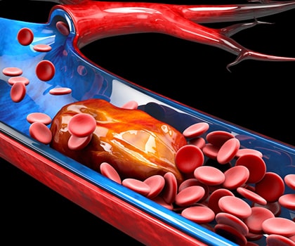 Pulmonary Embolism Thrombolysis