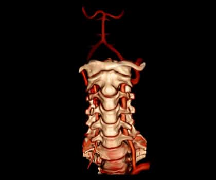 Vertebral Artery Stenting