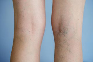 6 Tips for Varicose Vein Pain Relief