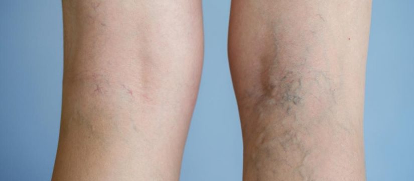 6 Tips for Varicose Vein Pain Relief