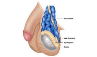 Varicocele embolization using image guidance