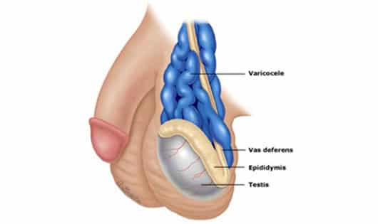 Varicocele Male Infertility Embolization Vascular Interventions