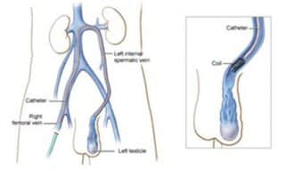 Varicocele and male infertility