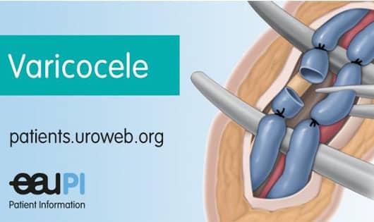 VARICOCELE -MALE INFERTILITY-EMBOLIZATION